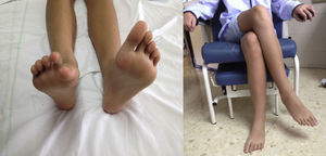 A) Imposibilidad para la extensión del primer dedo y debilidad para la flexión dorsal del pie derecho. B) Postura usual de la paciente al sentarse.