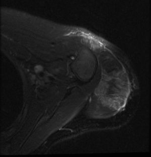 Hiperintensidad de señal en el deltoides y el bíceps, y engrosamiento de la fascia con estriación grasa subcutánea.