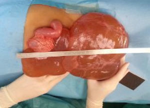 Caso número 1, de presentación crónica, con dolor abdominal de varios meses de evolución. Morfología pediculada, por lo que no precisó resección de asa.