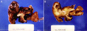 A) Imagen macroscópica: tumoración de 6×3× 5cm con estructura tubular correspondiente al extremo proximal del apéndice. B) Al corte, se observa tejido blanquecino en la zona media que incluye el apéndice cecal con fecalito.