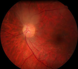 Funduscopia de polo posterior del ojo derecho, se observa masa traslúcida blanquecina junto a nervio óptico en la salida de los vasos temporales superiores.