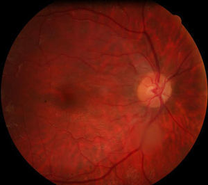 Funduscopia de polo posterior del ojo izquierdo, masa traslúcida blanquecina en trayecto de arcada vascular temporal inferior.