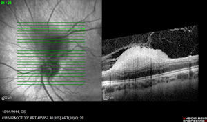 Imagen de tomografía de coherencia óptica del astrocitoma benigno del ojo derecho, se observa que la masa nace de las capas internas de la retina y protruye hacia el interior del globo ocular, sin infiltrar el epitelio pigmentario de la retina ni su membrana basal.