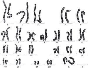 Cariotipo con isocromosoma X. En todas las metafases estudiadas se observan 46 cromosomas. Se observa alteración estructural consistente en un isocromosoma de los brazos largos de uno de los cromosomas X, variante de síndrome de Turner.