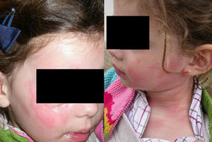 Aspecto clínico de la reacción tras jugar en la arena. Angioedema y habones en la cara, el cuello y el tórax.