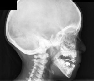 En la radiografía de cráneo, se aprecia aumento de densidad ósea en calota, huesos de la base y cuerpos vertebrales cervicales.