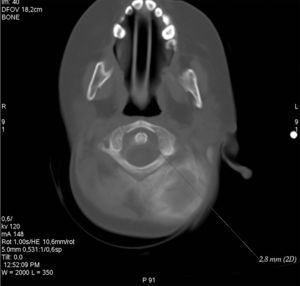 Tomografía computarizada multicorte sin contraste por vía intravenosa de columna cervical.