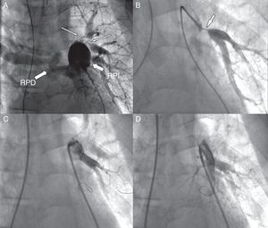 A) Angiografía del árbol pulmonar en la que se observa la tortuosidad de la rama pulmonar derecha (RPD), la gran dilatación de la rama pulmonar izquierda (RPI) y las estenosis filiformes (flechas) de 2 arterias segmentarias del pulmón izquierdo. B) Estenosis filiforme de una arteria segmentaria del lóbulo inferior izquierdo. C) La misma arteria segmentaria tras el implante de un stent. D) Angiografía tras el implante de 3 stents en la arteria lobar inferior izquierda y 2 arterias segmentarias.