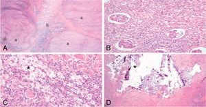 A) Grandes granulomas (a) comprimen el poco parénquima renal de la pieza (b). B) Nefritis intersticial por la presencia de células inflamatorias en el parénquima renal. C) Detalle de los granulomas con tejido inflamatorio crónico reagudizado (linfocitos, células plasmáticas, células multinucleadas y PMN) e histiocitos espumosos (*) (células de citoplasma claro por el acúmulo de lípidos en sus vacuolas), patognomónicos de la xantogranulomatosis y que confieren un aspecto amarillento característico al riñón. D) Focos cálcicos (*) compatibles con litiasis renales.