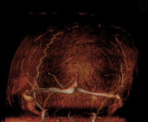 Trombosis venosa cerebral en paciente con leucemia linfoblástica aguda tratada con L-asparaginasa. RM venografía con contraste: ausencia de señal de flujo en el seno sagital superior.