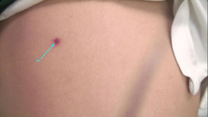Lesión violácea de 3 mm de diámetro localizada en abdomen.