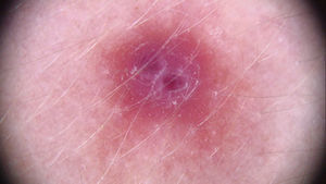 Imagen dermatoscópica que muestra lesión eritematosa con dos núcleos violáceos rodeados de un halo pálido.