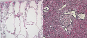 Enfermedad poliquística renal. Dilatación cilíndrica de todos los túbulos colectores, con revestimiento homogéneo por células cuboidales.