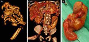 A) Reconstrucción 3D, VR en proyección oblicua izquierda: A1) estructura ósea del FiF; A2) parte del lóbulo hepático izquierdo eliminado para mejor visualización de la masa. Estructuras óseas del FiF de la misma densidad que las estructuras óseas del paciente. Se observa la vena esplénica (¥) desplazada craneal y anteriormente. El páncreas (no se observa) está desplazado anterior y cranealmente. El riñón izquierdo está rechazado lateral y anteriormente (*) y la vena renal izquierda (*) está elongada y anterior. El tronco celíaco (no se muestra) está elongado y desplazado cranealmente por encima de la masa. La vena cava inferior (#) y la arteria mesentérica superior ($) están lateralizadas hacia la derecha. B) Pieza quirúrgica: masa fetiforme con cordón umbilical.