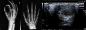 La radiografía simple muestra una lesión bien delimitada localizada en partes blandas, sin afectación ósea. La ecografía cutánea revela una lesión nodular sólida sin presencia de vasos sanguíneos en su interior.