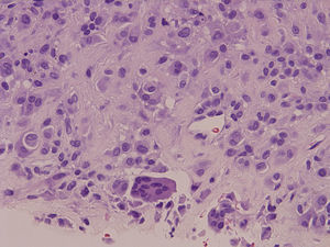 Tinción con hematoxilina-eosina (200×). Lesión adherida a la vaina tendinosa constituida por una proliferación histiocitaria con abundantes células gigantes multinucleadas.