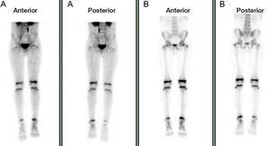 Gammagrafía ósea. A) Fase precoz. B) Fase tardía. Asimetría con menor captación en extremidad inferior derecha.