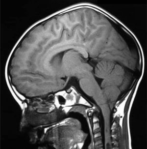 RM en secuencia T1. Malformación Arnold-Chiari tipo 1. Herniación caudal de las amígdalas cerebelosas por debajo del foramen magno.