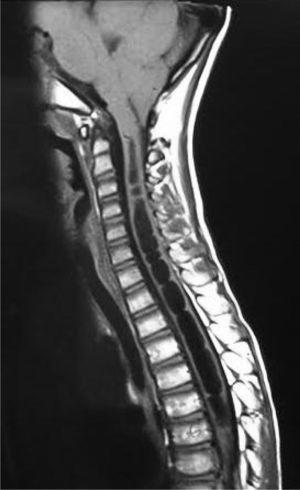 RM en secuencia T1. Cavidad siringomielia de C1 a T8.