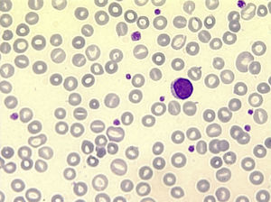 Anisocitosis eritrocitaria y macrotrombocito.