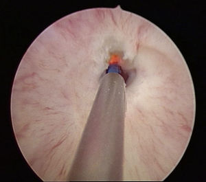 Estenosis de la uretra membranosa en imagen de cistoscopia y fulguración con láser.