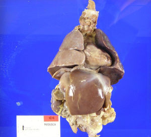 Una visión anatómica de los 2 pulmones morfológicos izquierdos, levocardia y levoápex, y situs abdominal.