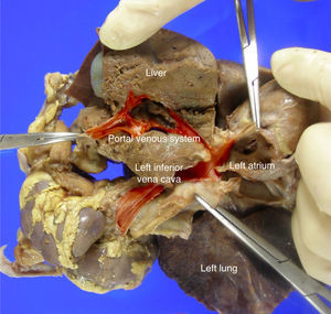 Conexión venosa sistémica infracardíaca hacia la aurícula izquierda. No es posible la visualización anatómica de las venas pulmonares dado la severa hipoplasia de las venas.