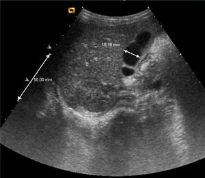 Reducción del tamaño de la vesícula biliar en la ecografía abdominal de control.
