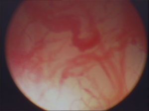 Superficie vesical con múltiples telangiectasias.