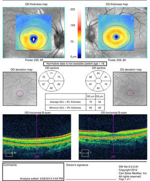 Análisis de la capa de células ganglionares y la plexiforme interna de la retina, que es normal en ambos ojos.