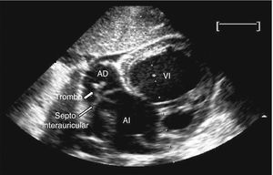 Ecocardiografía bidimensional, plano subcostal. Coágulo atravesando el foramen oval, entre aurícula derecha (AD) y aurícula izquierda (AI); VI: ventrículo izquierdo.