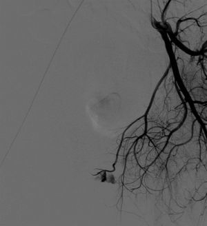 Arteriografía: laceración de la rama de la arteria obturadora izquierda.