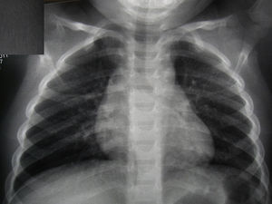 Radiografía de tórax posteroanterior. Normalización de la radiografía de tórax a los 2 meses del ingreso. Cúpula diafragmática íntegra.