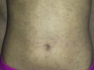 Máculas grisáceas ovaladas de pequeño tamaño en torso de nuestra paciente.