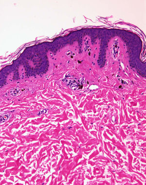 Ausencia de afectación de epidermis. Pigmentación de la capa basal epidérmica y melanófagos en dermis. Ausencia de daño de la capa basal e infiltrado liquenoide (hematosilina-eosina 10×).