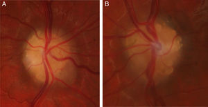 Drusas del nervio óptico en ojo izquierdo (A) y ojo derecho (B).