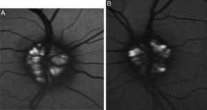 Autofluorescencia de las drusas del nervio óptico en ojo izquierdo (A) y ojo derecho (B).