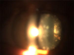 Biomicroscopía anterior en la que se aprecia catarata cerúlea y punto de Mittendorf atípico en área temporal inferior del ojo izquierdo.