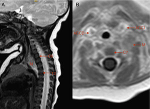Resonancia magnética nuclear craneocervicotorácica en la que se evidencia una masa (M) paraespinal izquierda de 19×12×25mm desde la altura del cuerpo vertebral de C6 a T2, sin signos de invasión del canal raquídeo, que desplaza anteriormente el tercio proximal de la ACCI y la subclavia izquierda, mínimamente heterogénea con intenso realce tras la administración de contraste, sugestiva de neuroblastoma o ganglioneuroblastoma. ACCD: arteria carótida común derecha; ACCI: arteria carótida común izquierda; C7: cuerpo vertebral de C7.