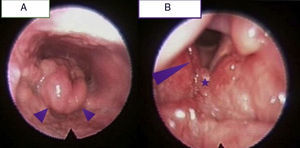 Aspecto de la laringe previo al tratamiento con corticoides. A) Epiglotis muy engrosada de aspecto granulomatoso que oblitera casi por completo el vestíbulo laríngeo (puntas de flecha). B) Corditis derecha (punta de flecha) con granuloma en comisura anterior (asterisco).
