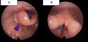 Aspecto de la laringe después del tratamiento con corticoides. A) Se aprecia una reducción significativa de la inflamación de la epiglotis (punta de flecha), mejorando de forma apreciable la luz a nivel del vestíbulo laríngeo (asterisco). B) Recuperación del aspecto normal de la cuerda vocal derecha (punta de flecha).