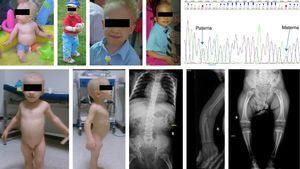 Parte superior: paciente del caso 1 a los 9 y 18 meses, y a los 5 y 7 años, respectivamente. Mutaciones encontradas en el gen RMRP. Parte inferior: paciente del caso 2 a los 4,5 años de edad e imágenes radiológicas a los 2 años de edad.