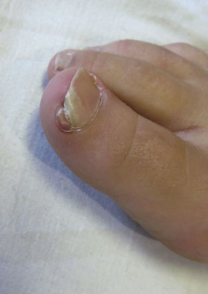 Nódulo parduzco en el surco lateral interno de la uña del primer dedo del pie derecho con onicodistrofia asociada. Se observa hiperqueratosis subungueal, onicólisis y un collarete epidérmico rodeando la lesión.