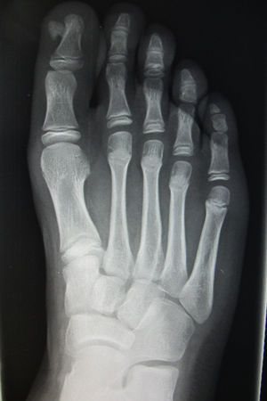 Radiografía simple del pie derecho, que muestra una excrecencia ósea en el borde lateral interno de falange distal.
