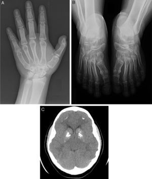 A) Anomalías óseas en la mano. B) Anomalías óseas de los pies. Nótese las alteraciones metacarpo-metatarsianas. C) TAC craneal. Nótese las calcificaciones en los ganglios de la base.