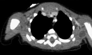 Tomografía computarizada torácica en el plano axial en la que se aprecia uno de los varios nódulos hipodensos dispersos por todo el cuerpo.