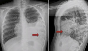 Radiografía de tórax del hospital de origen: se informa como neumonía complicada con empiema. Se puede observar una zona con un patrón hidroaéreo intratorácico (flecha)