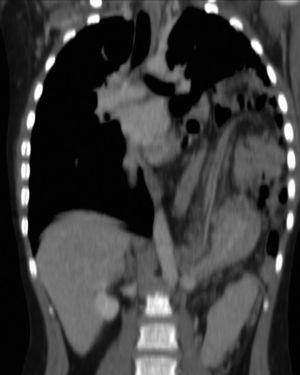 Hernia diafragmática posterior y lateral izquierda que contiene intestino (desde yeyuno a ángulo esplénico del colon), cuerpo-cola de páncreas y grasa mesentérica.