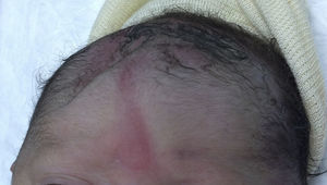 Imagen del hundimiento craneal advertido al nacimiento.