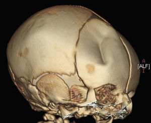 Reconstrucción en 3 dimensiones de la TC, craneal donde se advierte fractura con hundimiento del hueso frontal derecho.